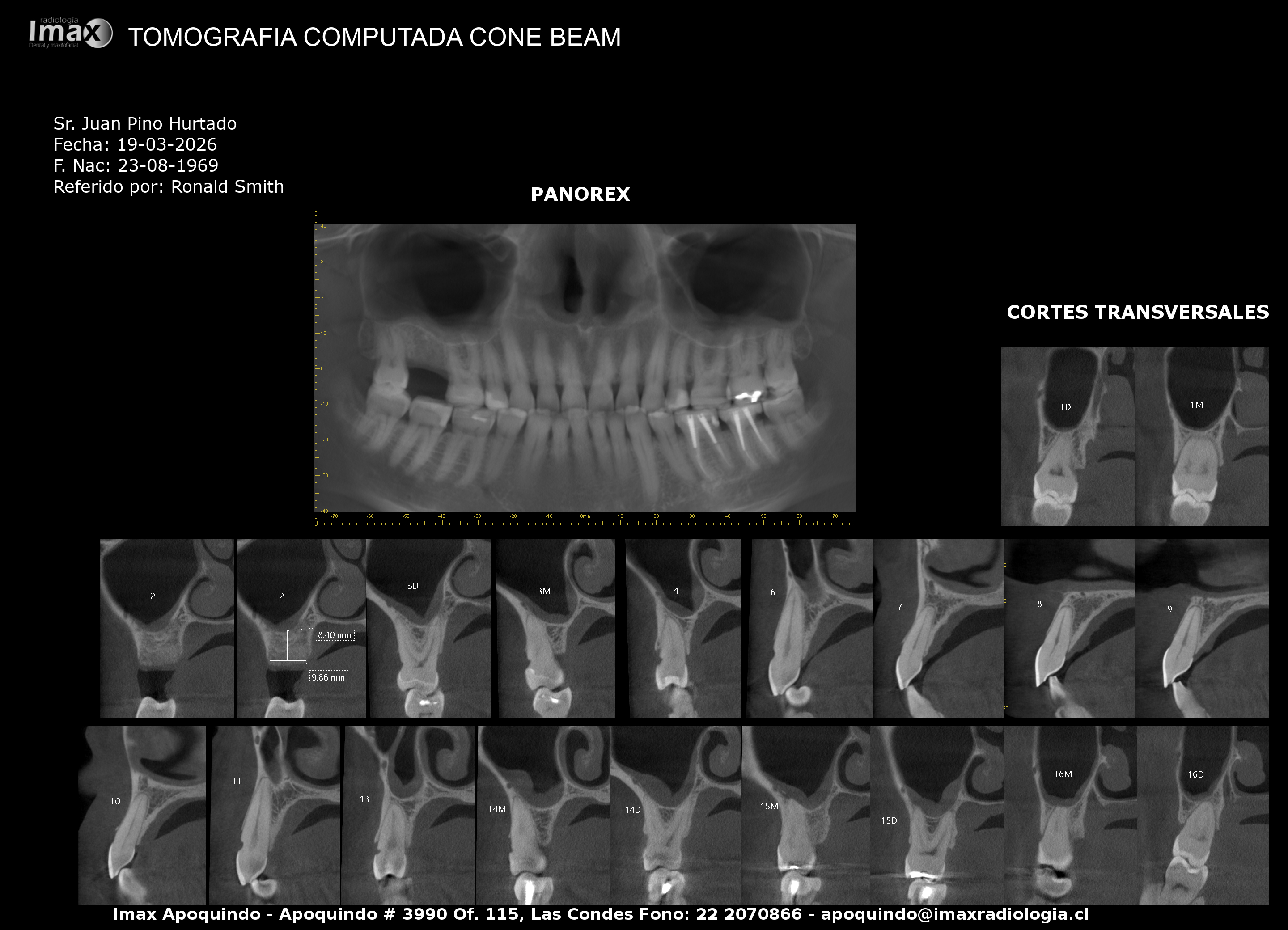 Planificación de implantes dentales